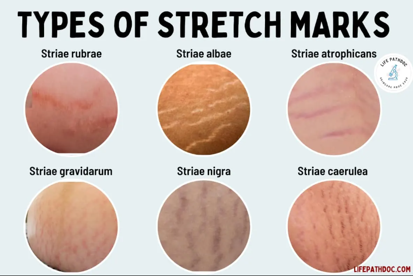 Understanding the Different Types of Stretch Marks 
