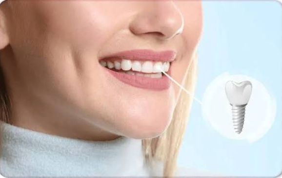 How Front Dental Implants Can Restore a Natural-Looking Smile