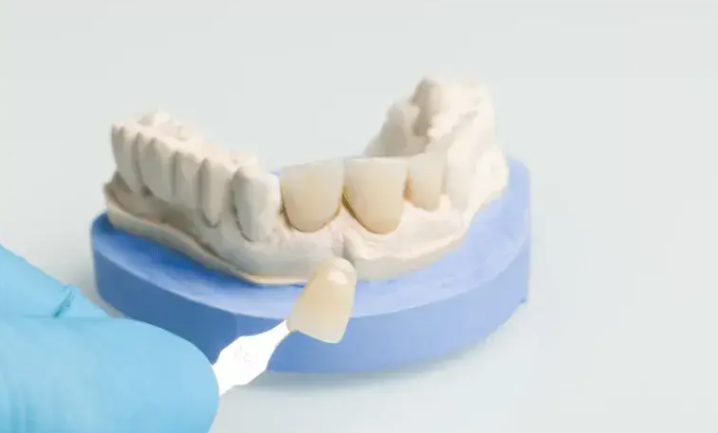 5 Questions To Ask About The Shape Of Your Final Implant Crown